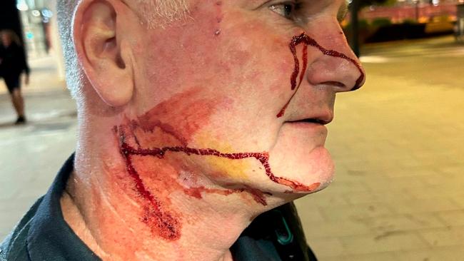 An AFP officer needed hospital treatment after being stabbed in the face and neck with a pen allegedly by a Jetstar passenger in Perth. Picture: Australian Federal Police