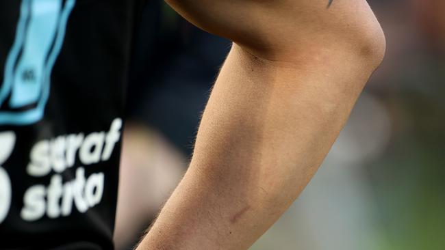 A mark can be seen on Shaun Johnson’s arm after the incident. Picture: Phil Hillyard.