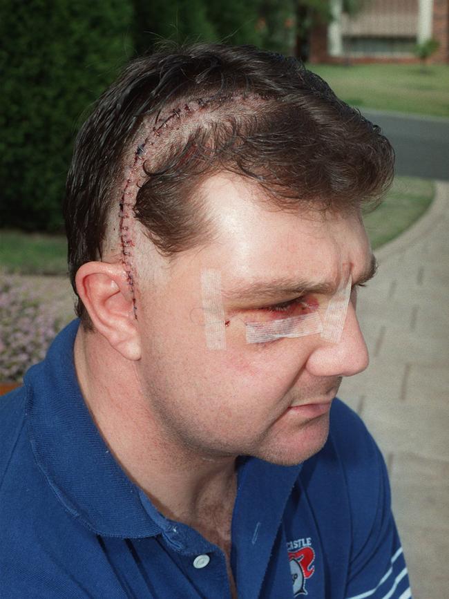 Glanville in 1996 after surgery for a fractured cheek bone.