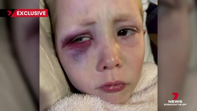 5yo bashed with a golf club by another kid