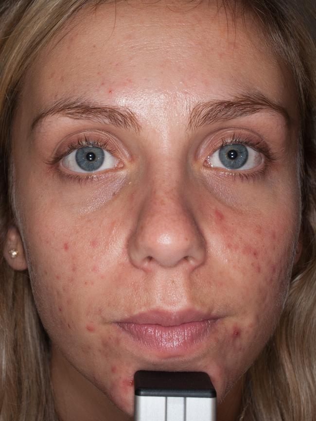 Natalie Walker developed acne in her 20s.