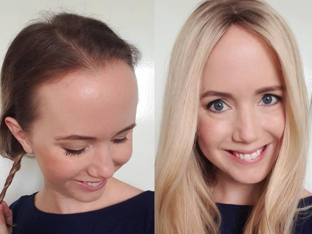 Alopecia Woman Shares Amazing Hair Loss Journey On Instagram Herald Sun