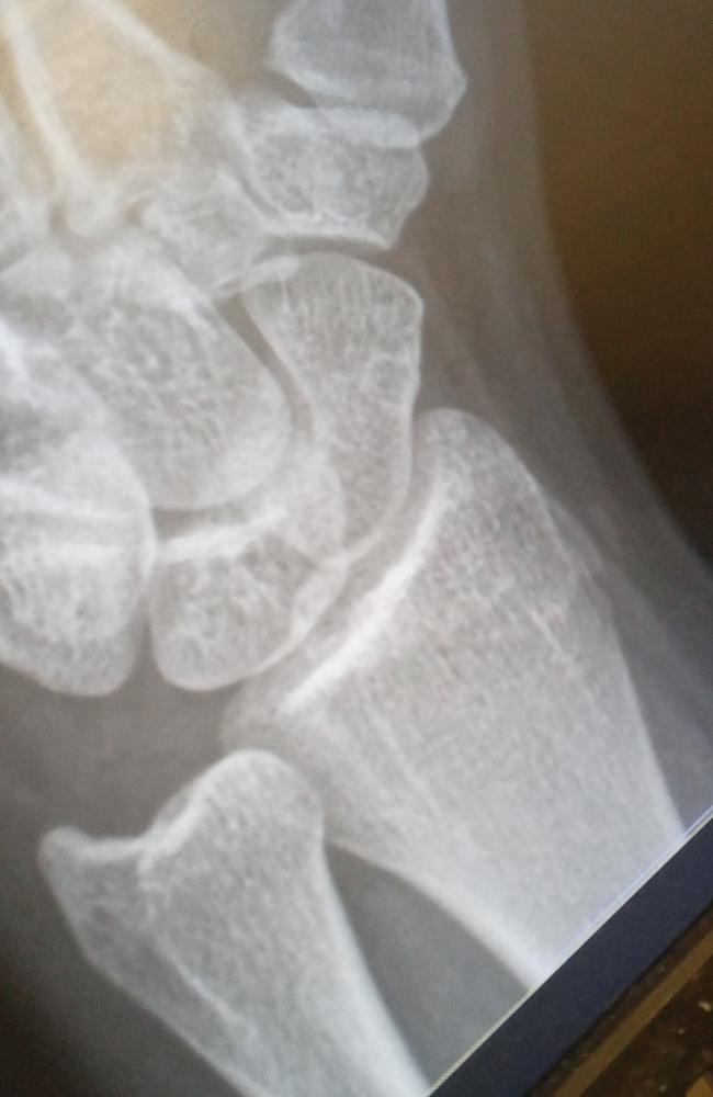 An X-ray of Alana’s fractured wrist.