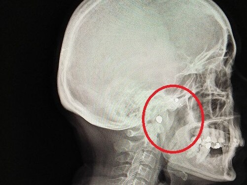 Basia Hellwich was shot three times by William Kelvin Fox in 1992. An x-ray shows a bullet still in her head. She also has bullet fragments in her body.