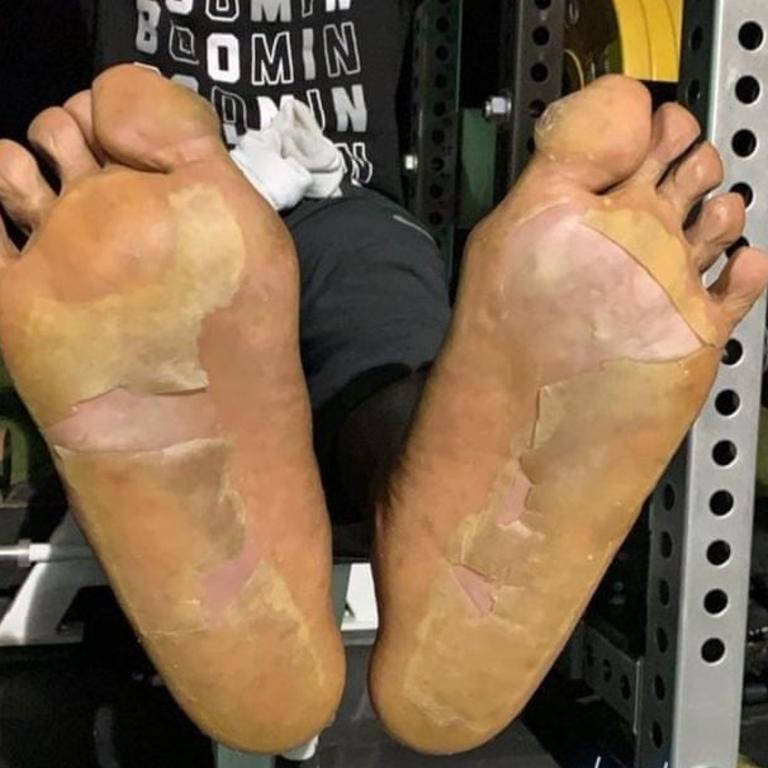 US footy player Antonio Brown suffered ‘extreme frostbite’ from the treatment. Picture: Instagram