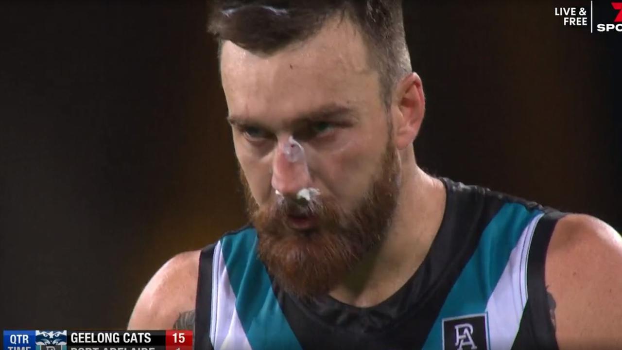 Port Adelaide's Charlie Dixon had to use an old-fashioned method after having his nose rearranged.
