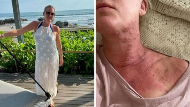 Jodie Oddy got shingles on her Bali holiday