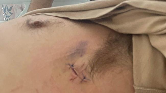 The injuries to Ryan Duck's chest after a knife was plunged through his bicep and into his chest. Picture: Supplied.