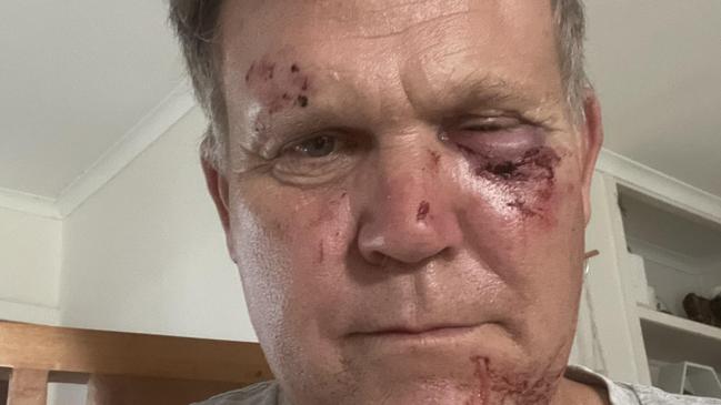 Holloways Beach resident Michael Trout was injured in an altercation on May 17. Picture: Supplied