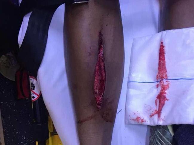 GRAPHIC: The injury to Isaac Quaynor's leg was severe.