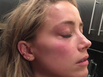 A close-up of Amber Heard’s bruised face was tendered as evidence. Picture: Supplied