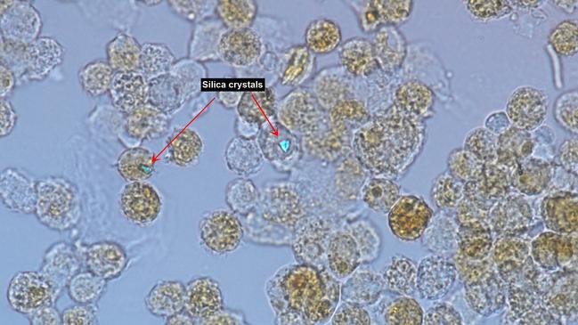 Cells taken from the lungs of a patient with silicosis. Notice the speck of silica dust shining brightly.