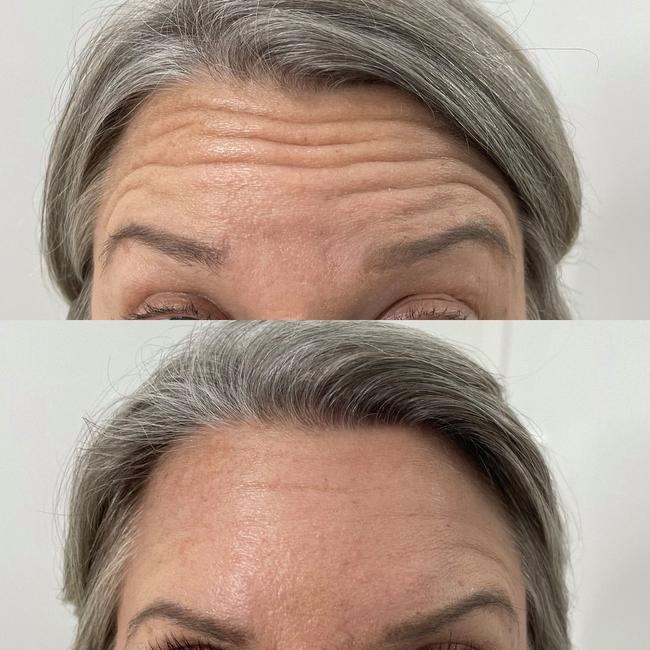 With anti-wrinkle injections, our experienced Registered nurses can create a natural-looking reduction in lines and wrinkles