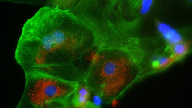 The placenta cells (in green) that are infected with the SARS-CoV-2 virus (Covid-19, in red). In blue are cell nuclei.