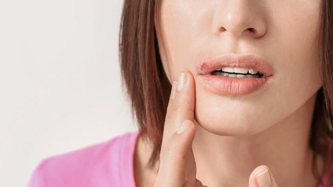 The virus that causes cold sores may be linked to the development of Alzheimer’s disease.