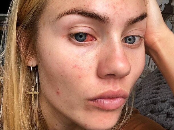 Elyse Knowles reveals struggle with acne. Pictures taken from instagram , https://www.instagram.com/elyse.knowles/