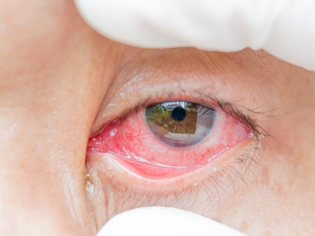 red bloodshot eye IStock image