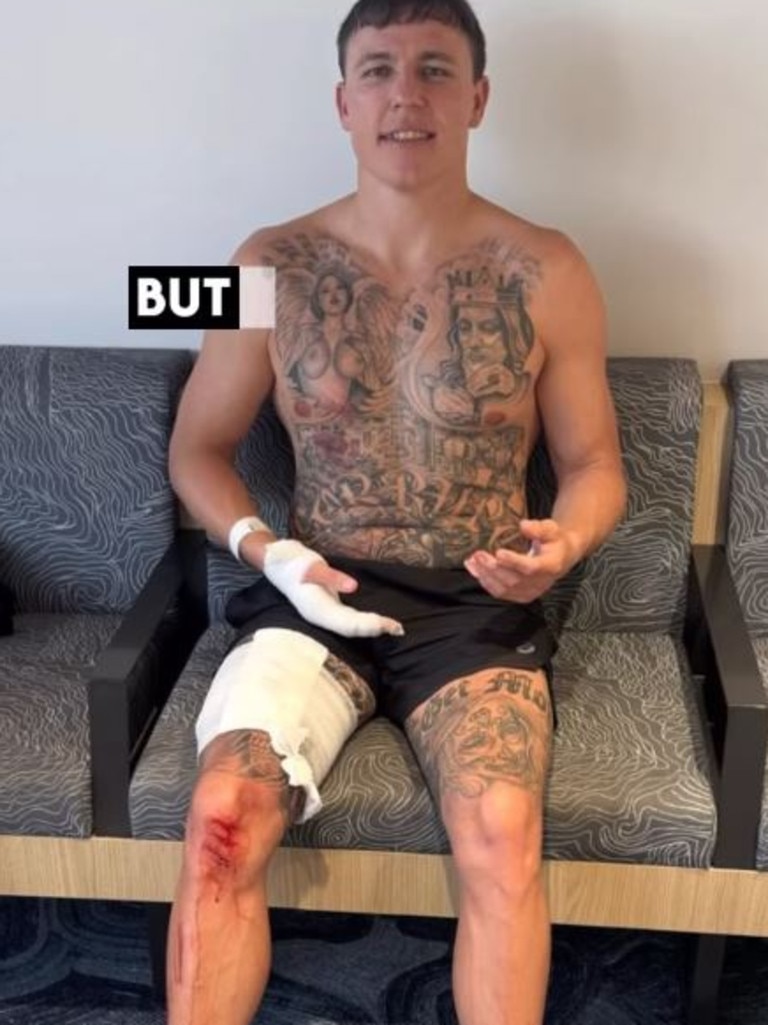 In true Aussie fashion he cracked a smile after his terrifying ordeal. Picture: Instagram/Jacob_little111