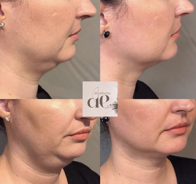 Before and after a Lipodissolve non-surgical treatment with Dr Edwina at Kailo.