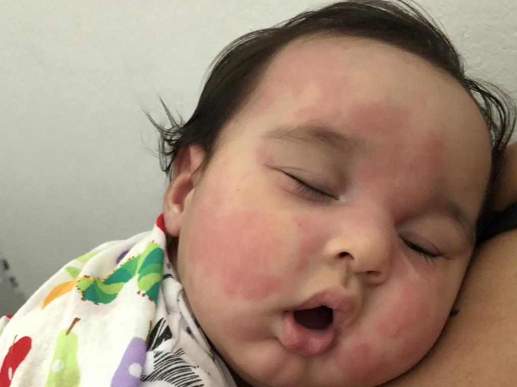 A family trip to Sydney and Adelaide left Isaiah covered in a red rash.