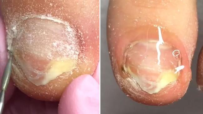 Beautician transforms decaying toenails
