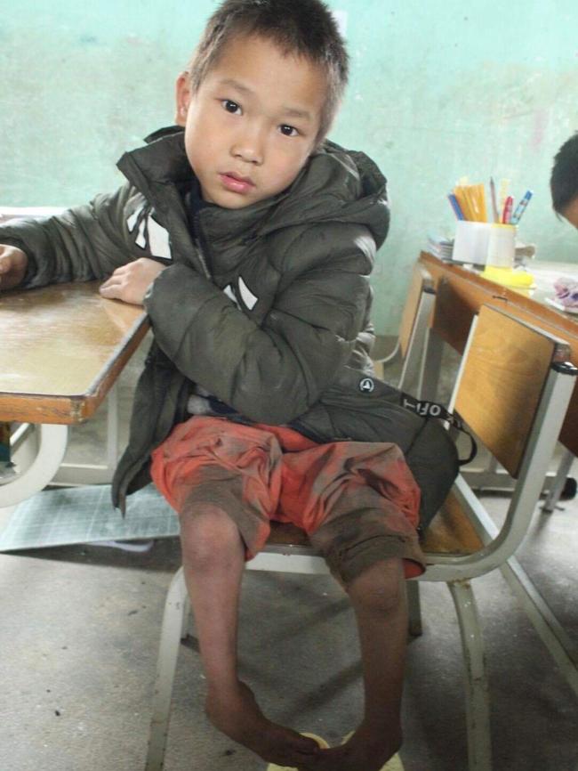 Chien Lu, in Vietnam with his clubfeet before surgery. Picture: Supplied