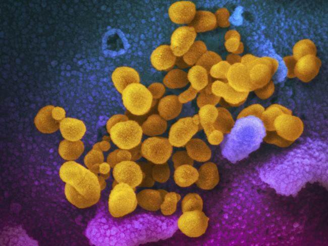 This undated electron microscope image made available by the U.S. National Institutes of Health in February 2020 shows the Novel Coronavirus SARS-CoV-2, yellow, emerging from the surface of cells, blue/pink, cultured in the lab. Also known as 2019-nCoV, the virus causes COVID-19. On Friday, April 3, 2020, The Associated Press reported on stories circulating online incorrectly asserting that eating alkaline foods will stave off the novel coronavirus, which has a pH level of 5.5 to 8.5. Donald Schaffner, extension specialist in food science at Rutgers University, told the AP. â€œThe human body is designed to be really good at maintaining its pH. â€¦ the best way to keep from getting a virus is to stay away from people.â€ (NIAID-RML via AP)