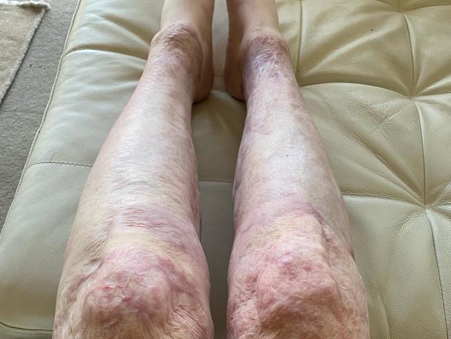 Stephanie recorded her journey as she healed from horrific burns. Picture: Instagram