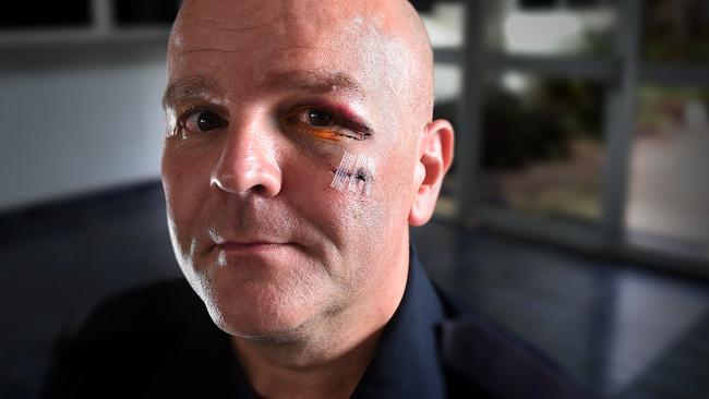 Constable Nick Carter shows the scars from an alleged attack outside Monsoons on Friday night. PICTURE: Patrina Malone