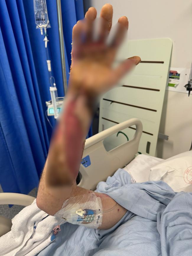 He endured 12 surgeries.