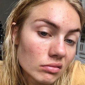 Elyse Knowles has always been open about her struggles with acne. Picture: Instagram.