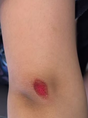 One of the young girls received a carpet burn as a result of being pushed into a wall by van der Poel. Picture: Supplied