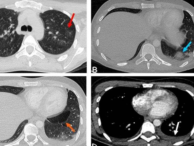 The effects of cocaine use on the lungs. Figure 2: Chest CT scan showing bilateral ground-glass opacities (A), consolidations (B), emphysematous bullae (C), and pleural effusion (D). Red arrow: ground-glass pattern. Blue arrow: pulmonary consolidation. Orange arrow: emphysematous bullae. White arrow: left pleural effusion