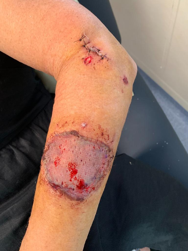 Toowoomba woman Vyvyan Glover's arm after she was operated on following a dog attack, that saw her need a skin graft on her left arm for a large wound she suffered as a result. Photo: Contributed.