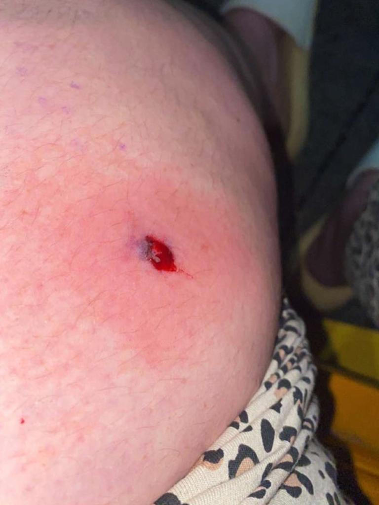 The wound left on Kayla’s leg after the incident. Picture: Supplied