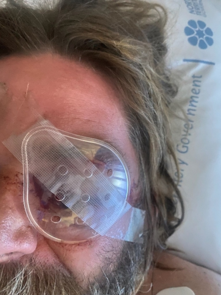 Matt had surgery on his eye late on Thursday afternoon but on Friday morning was still waiting to hear from doctors about whether he would lose his eye.