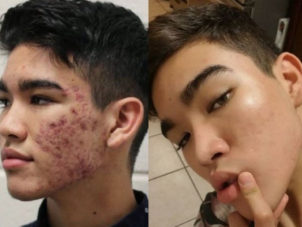 This teenager's before and after photos of acne.