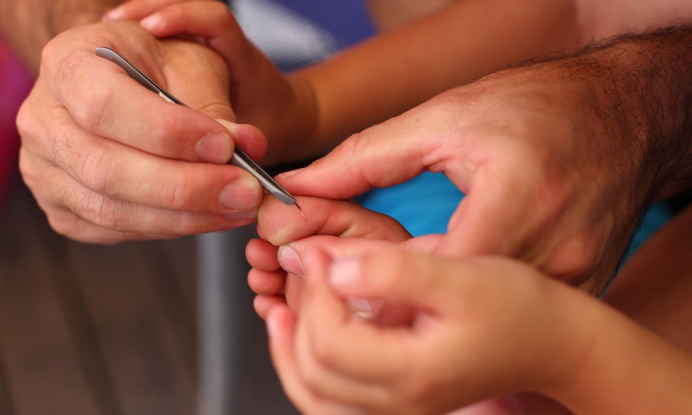 How To Remove Splinters At Home Kidspot