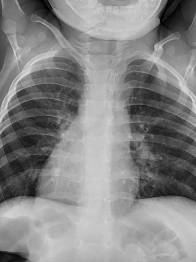 An x-ray showing Noah’s heart on the right side.