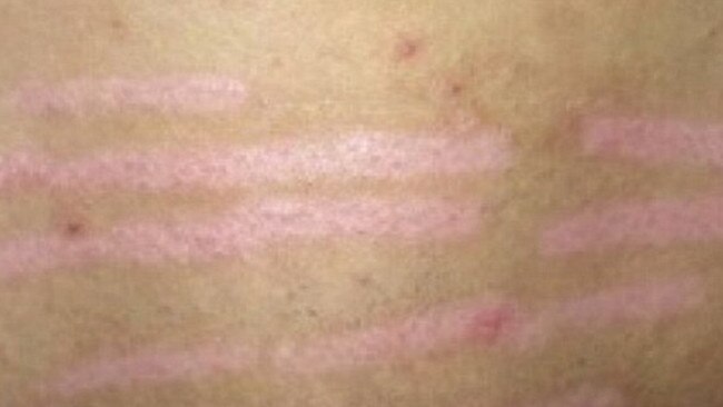 Following the burns the woman was left with scarring and returned to the laser clinic. Picture: Helen Golisano