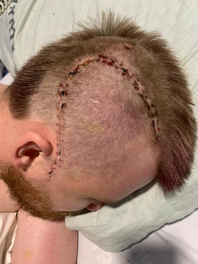 Harry Frolling bears the scars of surgery to repair his fractured skull and alleviate bleeding on the brain. Picture: Shane Froling/Twitter