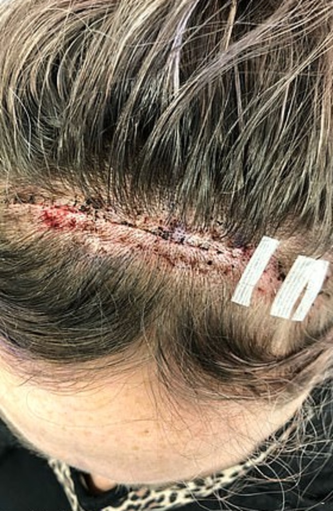 Lana from when she had an operation on her brain to remove a 1.5cm tumour. Picture: Supplied