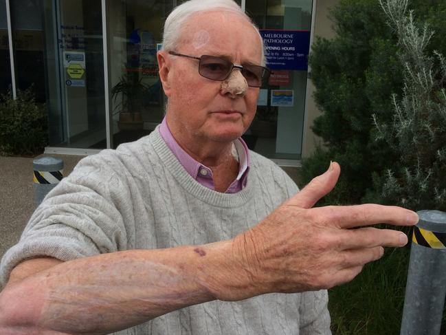 Former Olympian Neil Hewitt, 80, has been left with extensive scarring. Picture: Christian Tatman