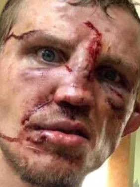 Jason Knight shows off his battle scars after fighting Artem Lobov. Picture: Supplied