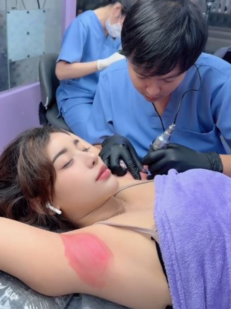 The procedure can be done on a variety of body parts. Picture: TikTok/tikkaau