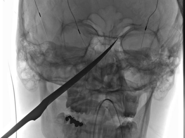 An X-Ray image of the skull of Eli Gregg.