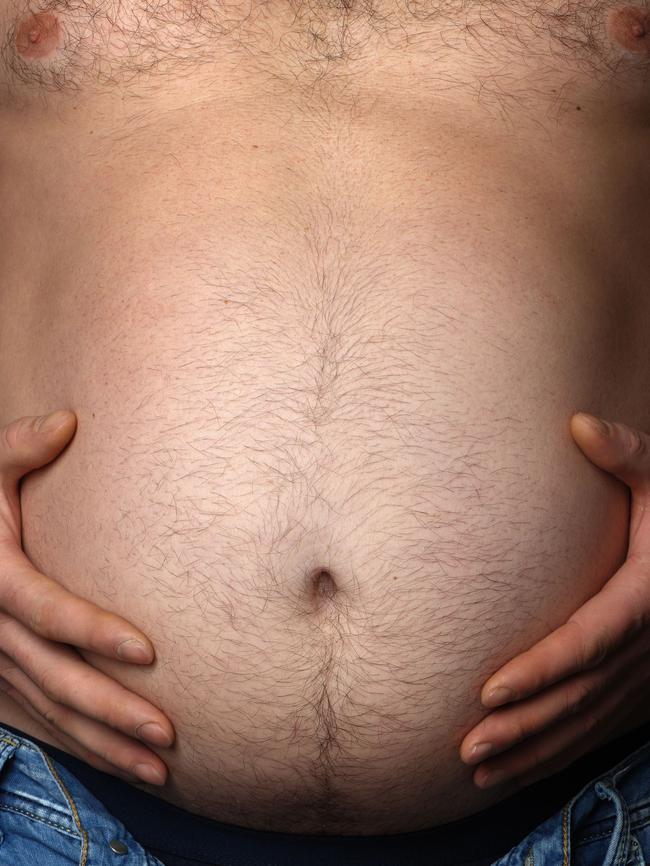 Problems ... Plicate patients are having their obesity surgery reversed or repaired in public hospitals. Picture: Supplied