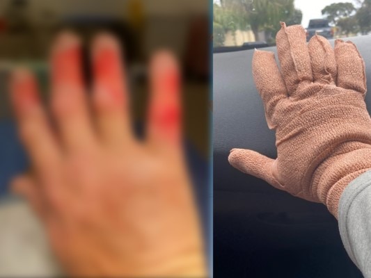 Aussie hiker Andrew Lane woke with serious burns on his hand after fainting from dehydration on a hot day. Picture: Andrew Lane/6PR