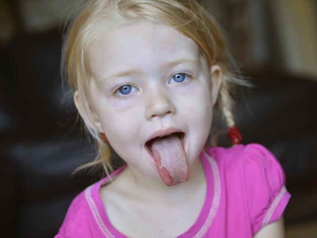 KJ Austin, 4 and his sister Saffire, 3 have been infected with hand, foot and mouth disease. KJ, 4 with sisters Saffire, 3 and Ruby-Lee, 23 months. Photo Christopher Chan / The Observer