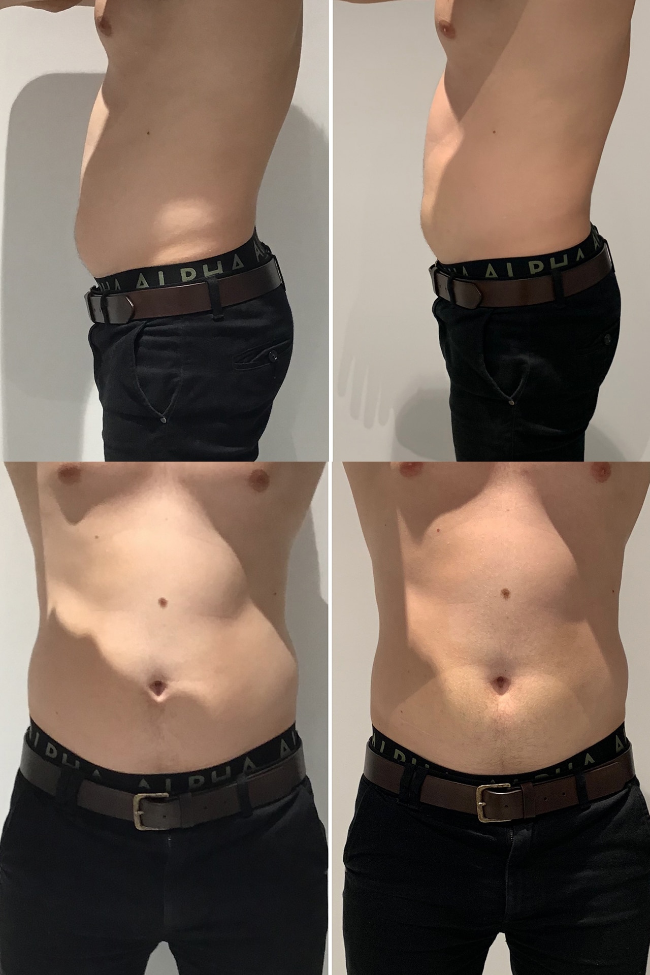 Body Sculpting, Lipo Hifu